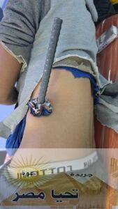 نجاح جراحة معقدة بالمستشفى العام