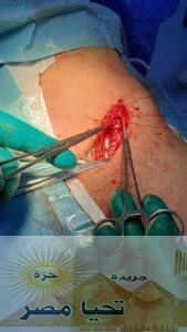 نجاح جراحة معقدة بالمستشفى العام