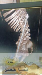 نجاح جراحة معقدة بالمستشفى العام